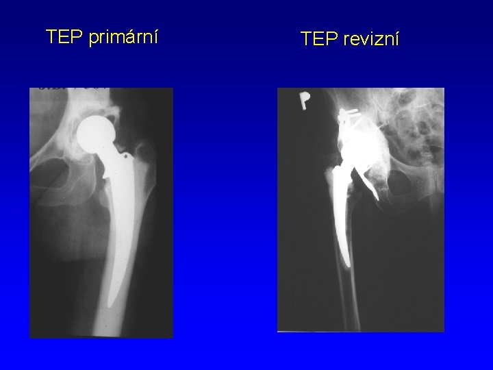 TEP primární TEP revizní 