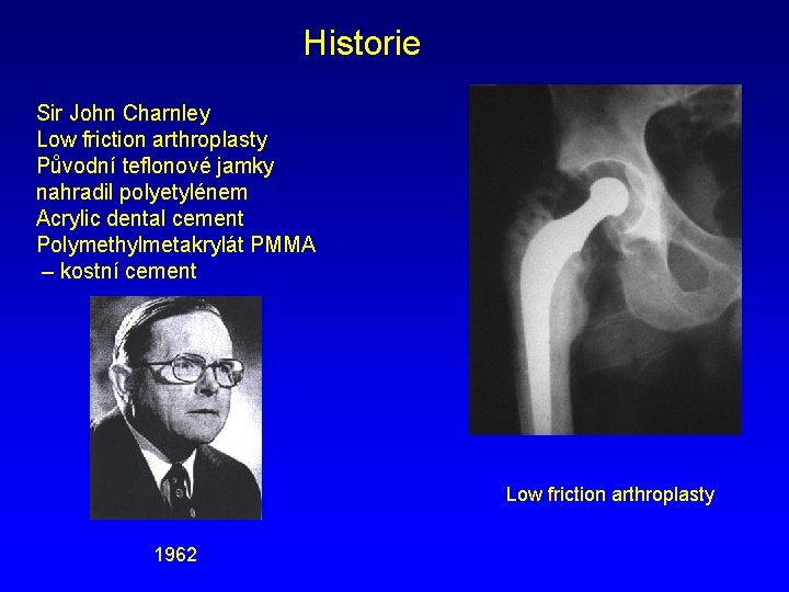 Historie Sir John Charnley Low friction arthroplasty Původní teflonové jamky nahradil polyetylénem Acrylic dental