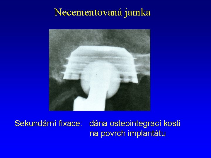 Necementovaná jamka Sekundární fixace: dána osteointegrací kosti na povrch implantátu 
