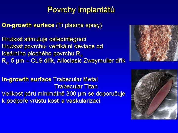 Povrchy implantátů On-growth surface (Ti plasma spray) Hrubost stimuluje osteointegraci Hrubost povrchu- vertikální deviace