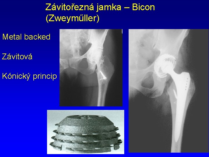 Závitořezná jamka – Bicon (Zweyműller) Metal backed Závitová Kónický princip 