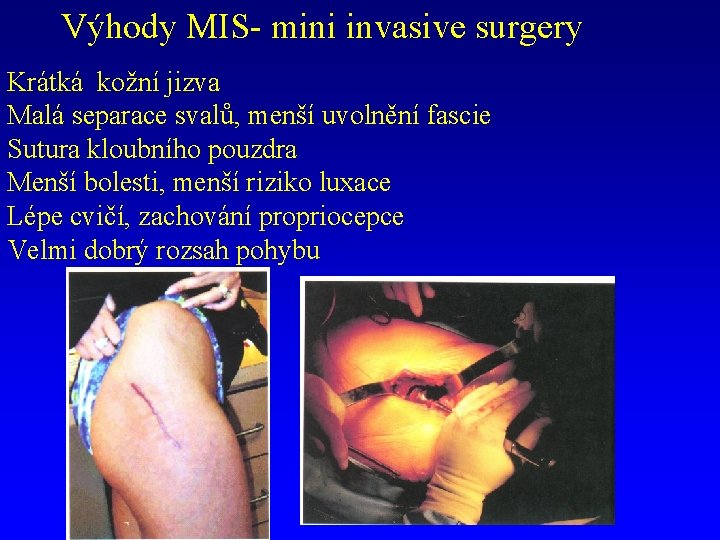 Výhody MIS- mini invasive surgery Krátká kožní jizva Malá separace svalů, menší uvolnění fascie