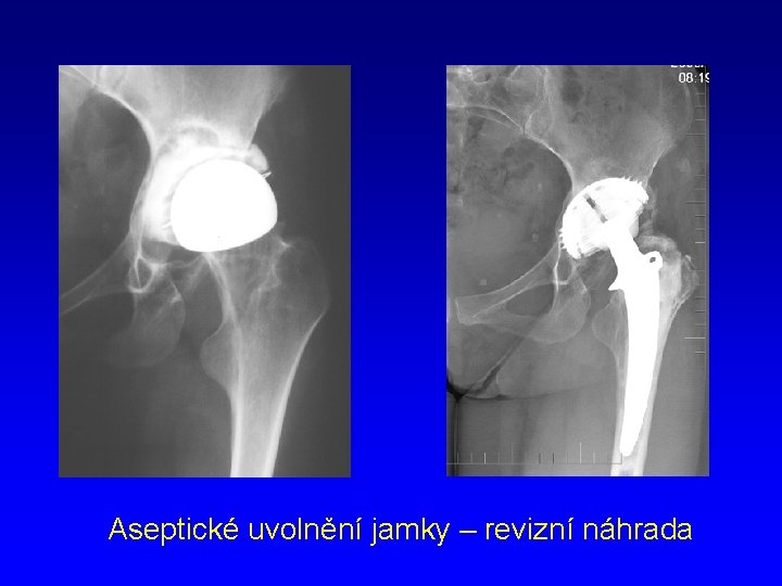 Aseptické uvolnění jamky – revizní náhrada 