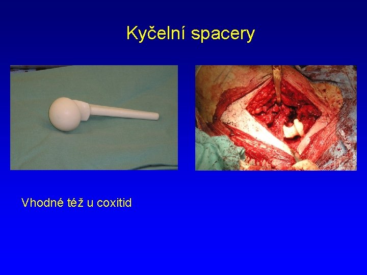 Kyčelní spacery Vhodné též u coxitid 