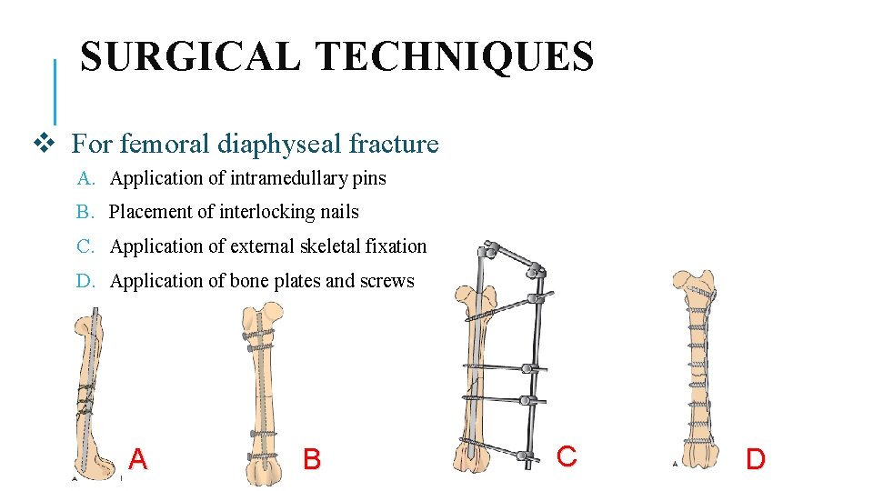 SURGICAL TECHNIQUES v For femoral diaphyseal fracture A. Application of intramedullary pins B. Placement