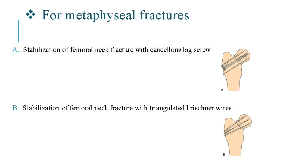 v For metaphyseal fractures A. Stabilization of femoral neck fracture with cancellous lag screw