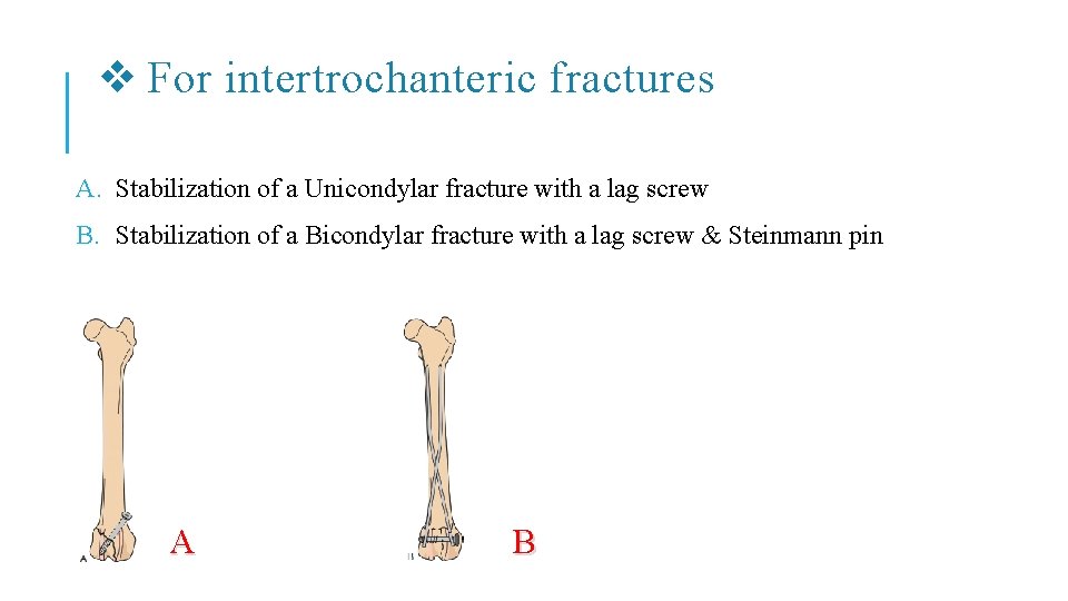 v For intertrochanteric fractures A. Stabilization of a Unicondylar fracture with a lag screw