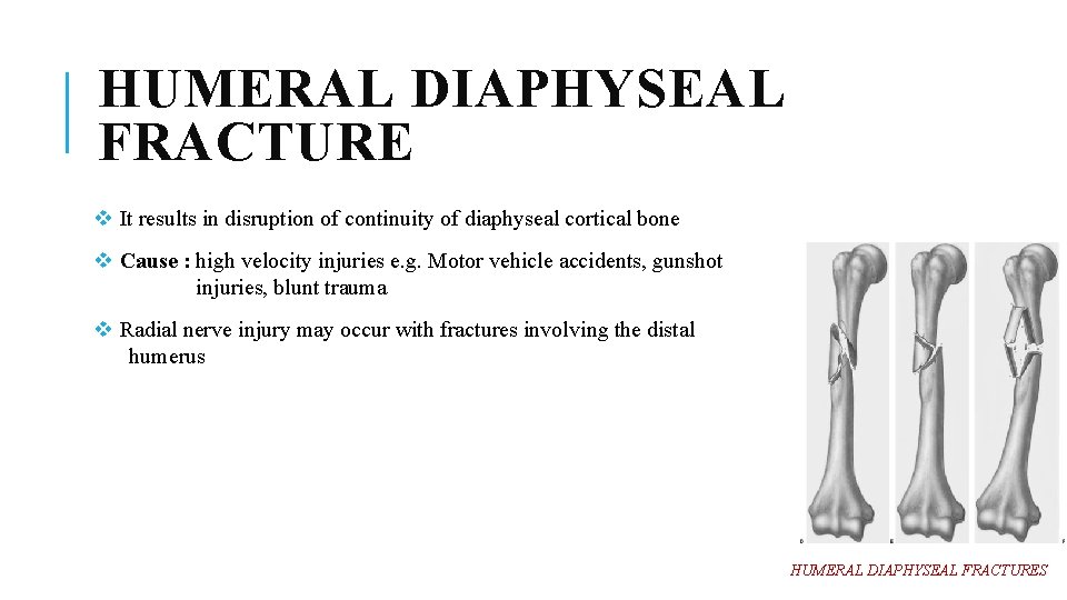 HUMERAL DIAPHYSEAL FRACTURE v It results in disruption of continuity of diaphyseal cortical bone