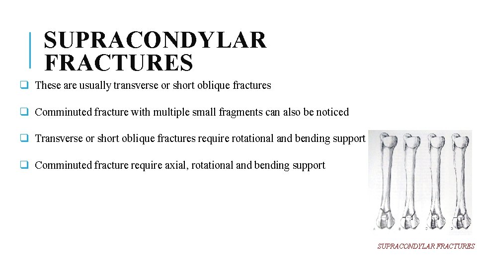 SUPRACONDYLAR FRACTURES q These are usually transverse or short oblique fractures q Comminuted fracture