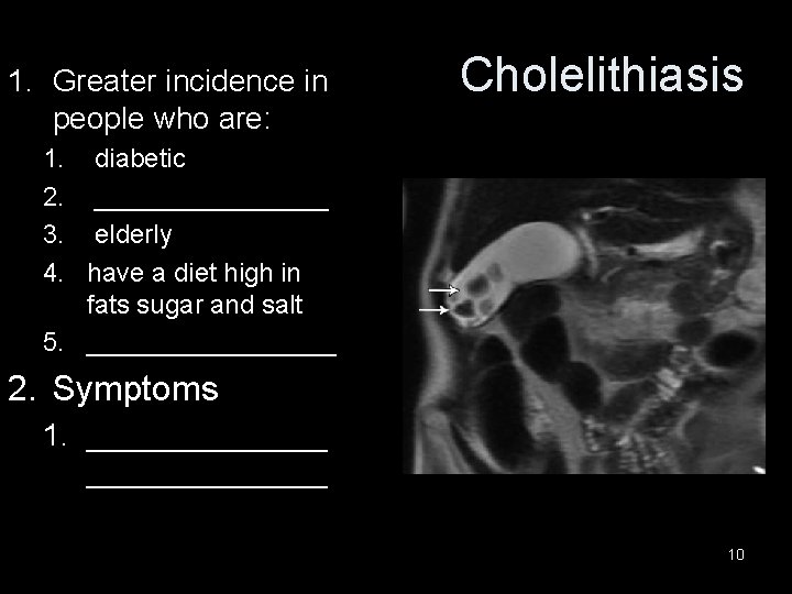 1. Greater incidence in people who are: Cholelithiasis 1. diabetic 2. ________ 3. elderly