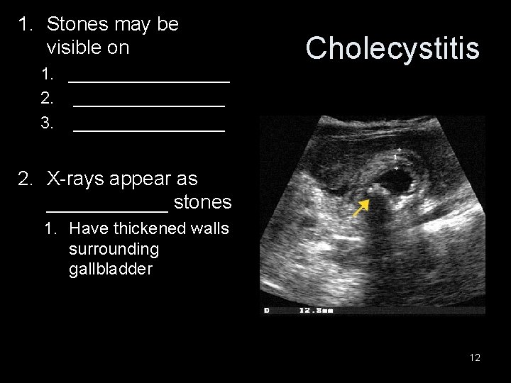 1. Stones may be visible on 1. _________ 2. ________ 3. ________ Cholecystitis 2.