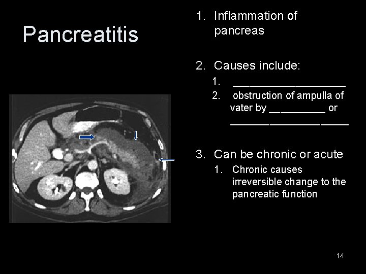 Pancreatitis 1. Inflammation of pancreas 2. Causes include: 1. 2. __________ obstruction of ampulla