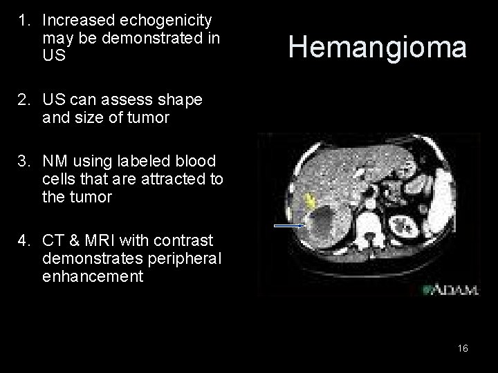 1. Increased echogenicity may be demonstrated in US Hemangioma 2. US can assess shape