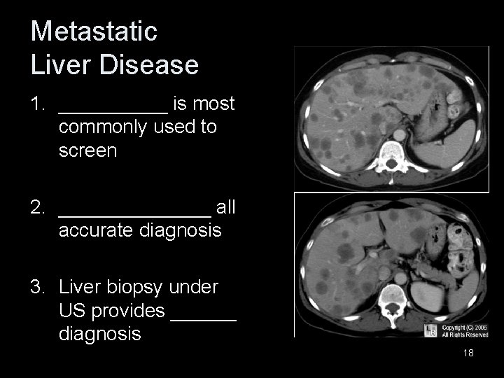 Metastatic Liver Disease 1. _____ is most commonly used to screen 2. _______ all