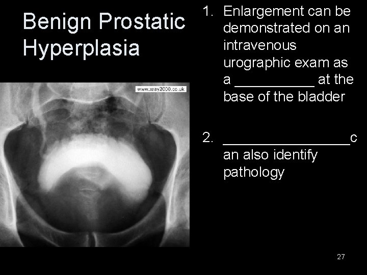 Benign Prostatic Hyperplasia 1. Enlargement can be demonstrated on an intravenous urographic exam as