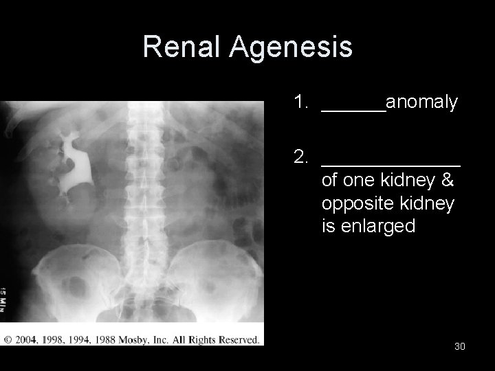 Renal Agenesis 1. ______anomaly 2. _______ of one kidney & opposite kidney is enlarged