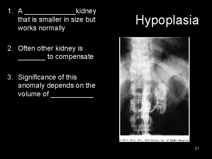 1. A _______kidney that is smaller in size but works normally Hypoplasia 2. Often