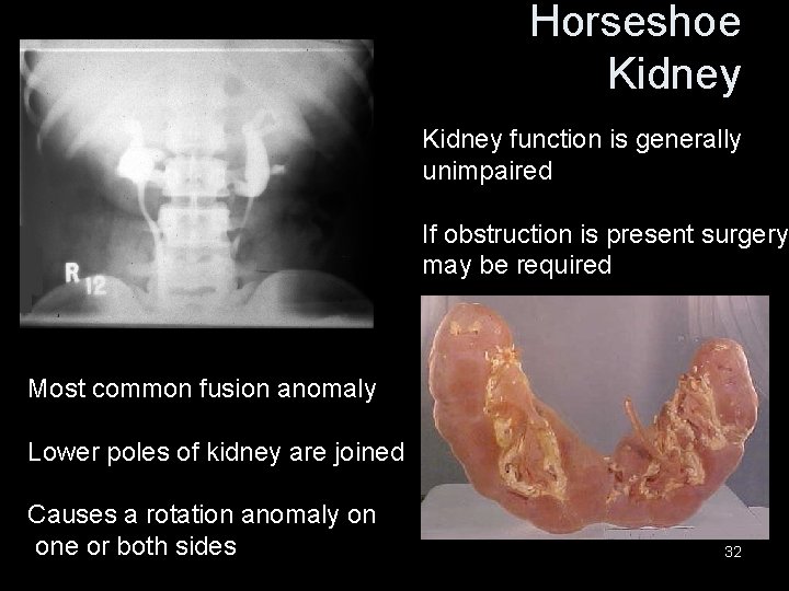 Horseshoe Kidney function is generally unimpaired If obstruction is present surgery may be required