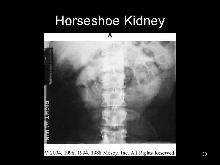 Horseshoe Kidney 33 