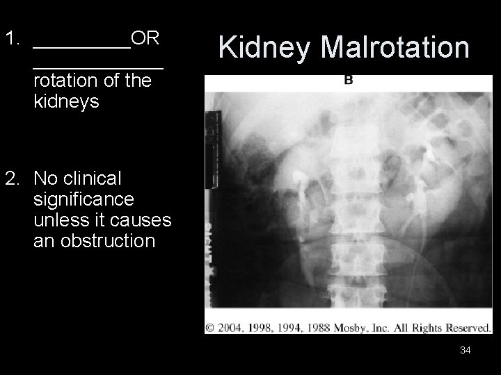 1. _____OR ______ rotation of the kidneys Kidney Malrotation 2. No clinical significance unless