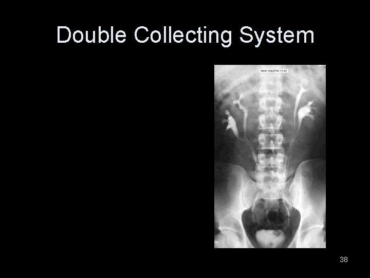 Double Collecting System 38 