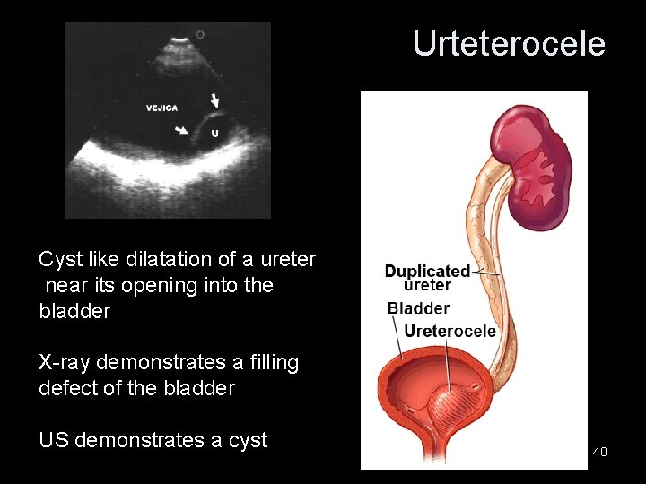 Urteterocele Cyst like dilatation of a ureter near its opening into the bladder X-ray