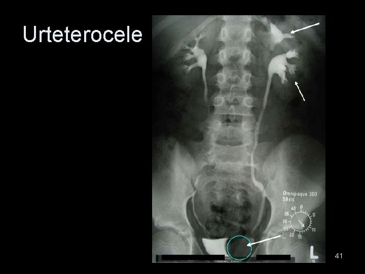 Urteterocele 41 