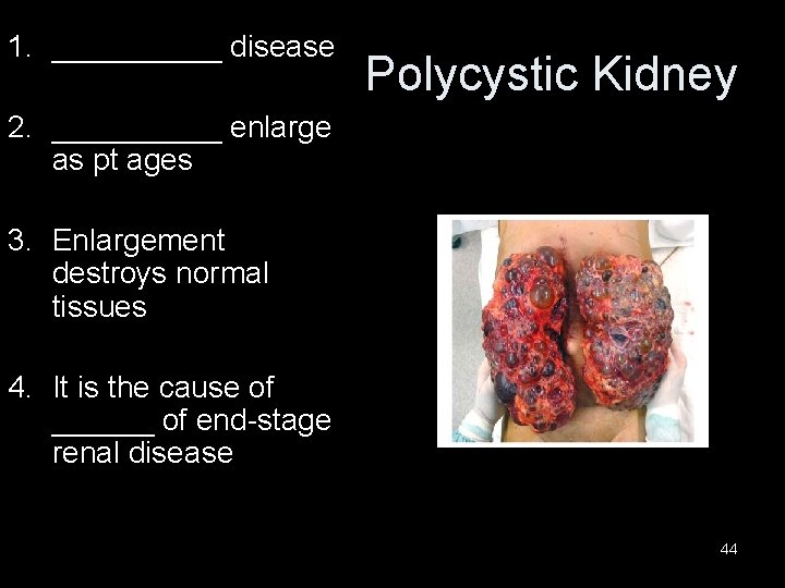 1. _____ disease Polycystic Kidney 2. _____ enlarge as pt ages 3. Enlargement destroys