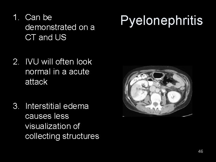 1. Can be demonstrated on a CT and US Pyelonephritis 2. IVU will often