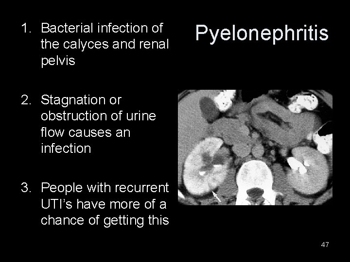 1. Bacterial infection of the calyces and renal pelvis Pyelonephritis 2. Stagnation or obstruction