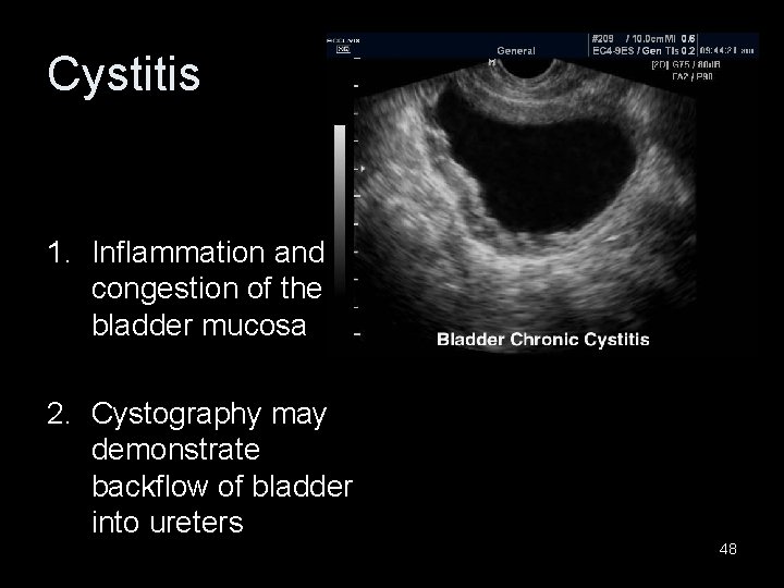 Cystitis 1. Inflammation and congestion of the bladder mucosa 2. Cystography may demonstrate backflow