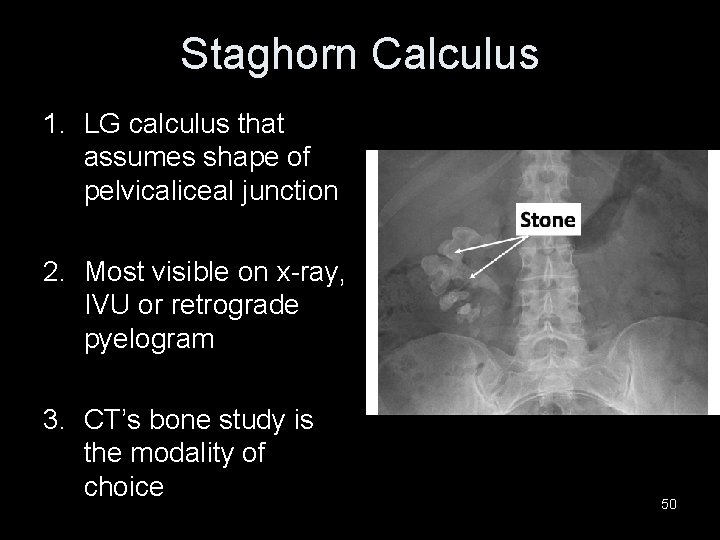 Staghorn Calculus 1. LG calculus that assumes shape of pelvicaliceal junction 2. Most visible