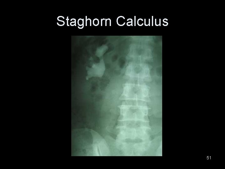 Staghorn Calculus 51 