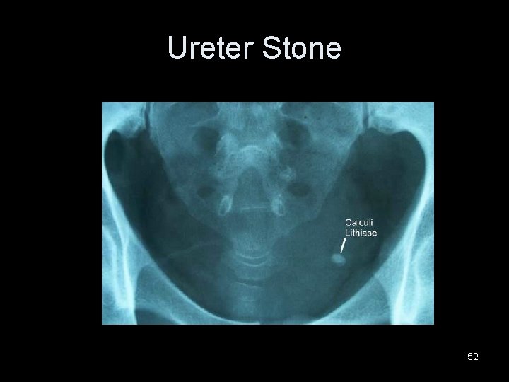 Ureter Stone 52 
