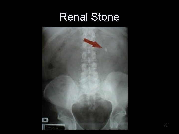 Renal Stone 56 