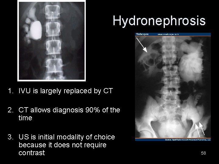 Hydronephrosis 1. IVU is largely replaced by CT 2. CT allows diagnosis 90% of