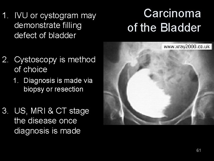 1. IVU or cystogram may demonstrate filling defect of bladder Carcinoma of the Bladder