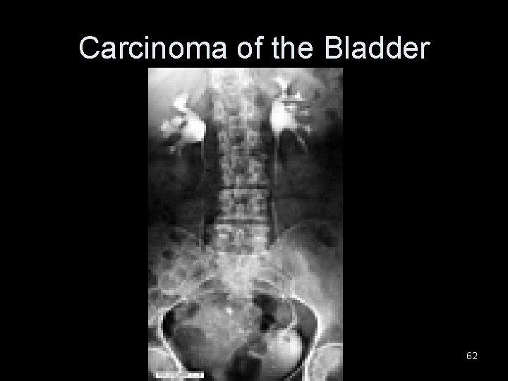 Carcinoma of the Bladder 62 