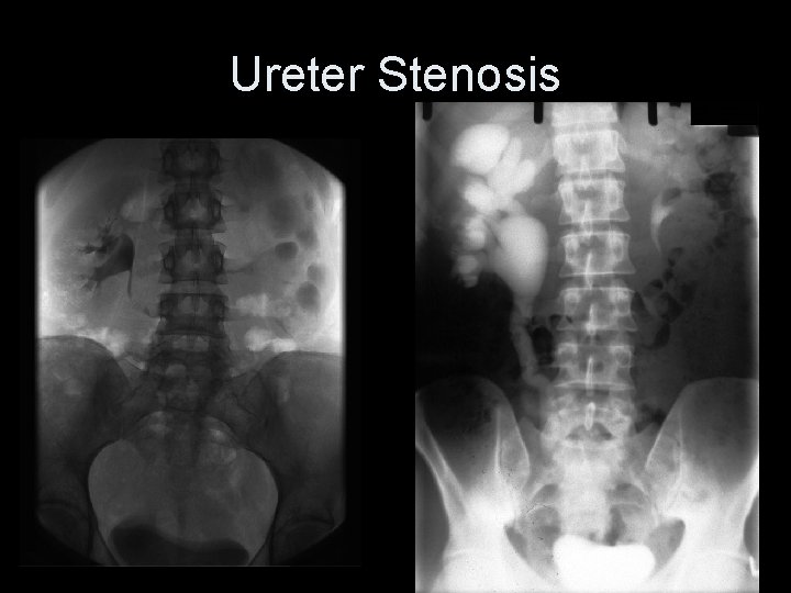 Ureter Stenosis 63 