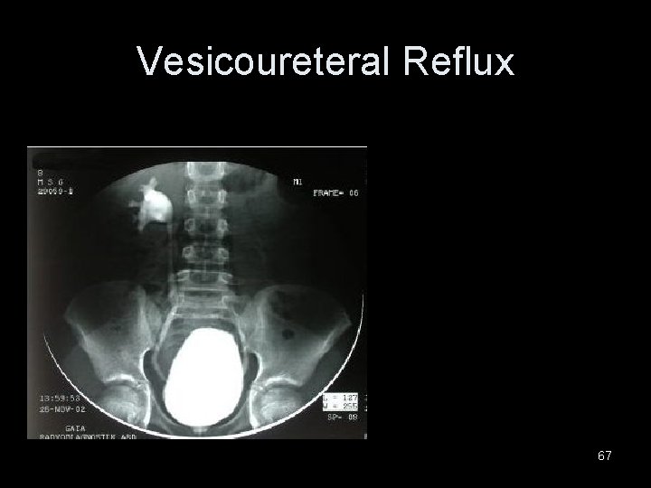 Vesicoureteral Reflux 67 