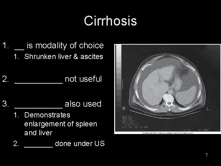 Cirrhosis 1. __ is modality of choice 1. Shrunken liver & ascites 2. _____