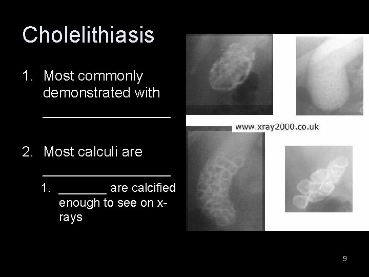 Cholelithiasis 1. Most commonly demonstrated with ________ 2. Most calculi are ________ 1. _______