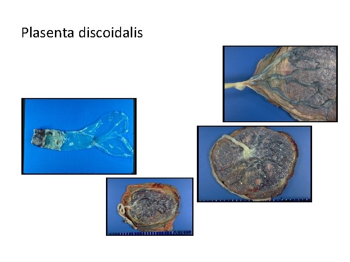 Plasenta discoidalis 