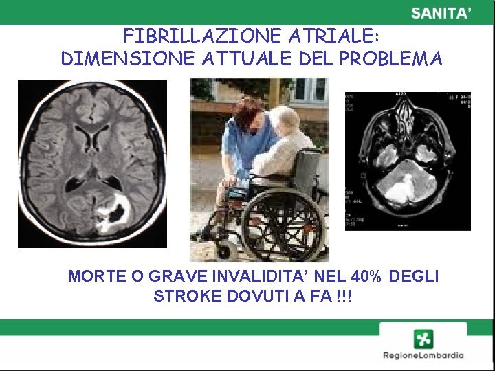 FIBRILLAZIONE ATRIALE: DIMENSIONE ATTUALE DEL PROBLEMA MORTE O GRAVE INVALIDITA’ NEL 40% DEGLI STROKE