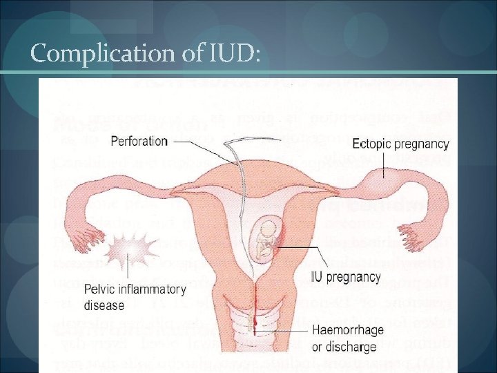 Complication of IUD: 