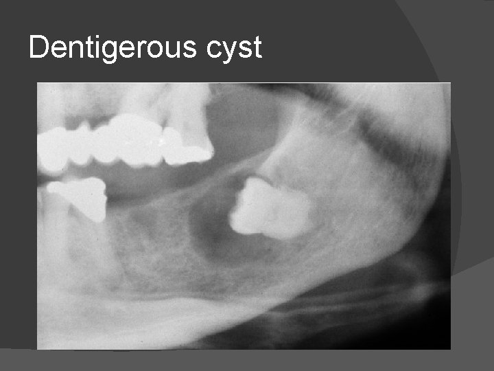 Dentigerous cyst 