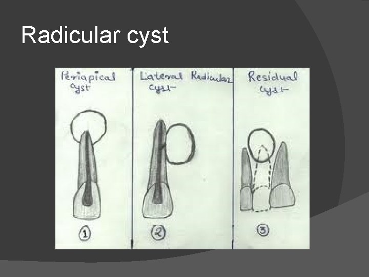 Radicular cyst 