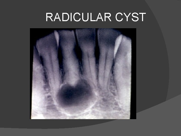 RADICULAR CYST 