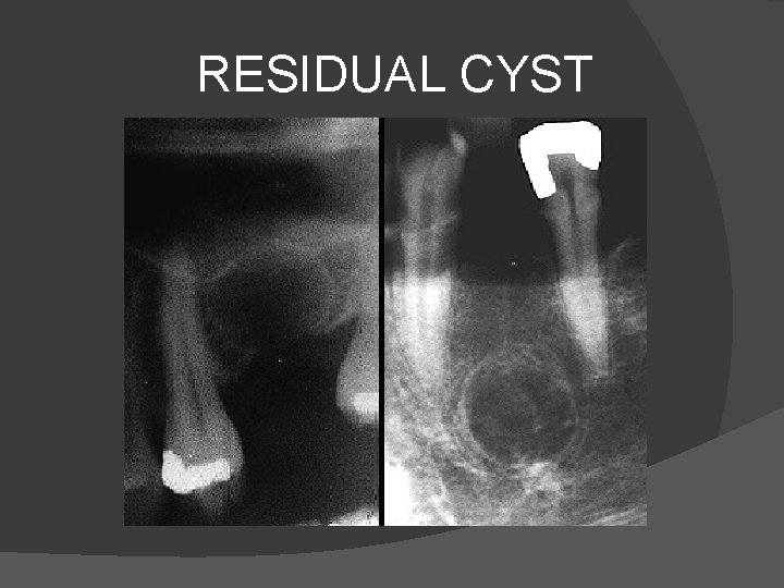 RESIDUAL CYST 