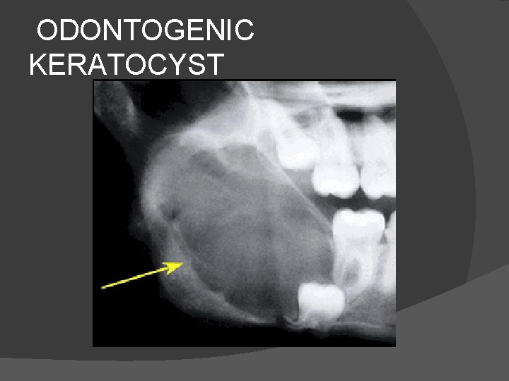 ODONTOGENIC KERATOCYST 